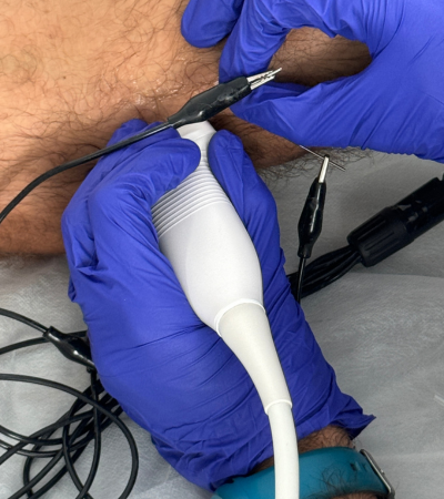 Tratamiento electrólisis percutánea tratamientos de fisioterapia en el campello